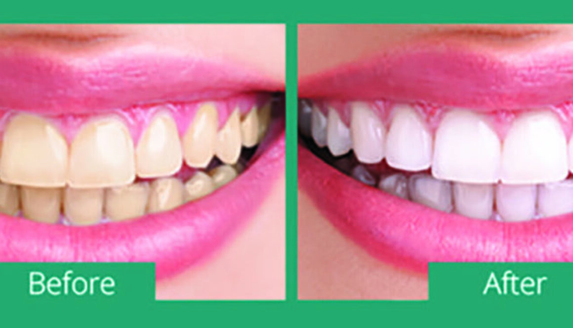 myths-and-facts-about-teeth-whitening