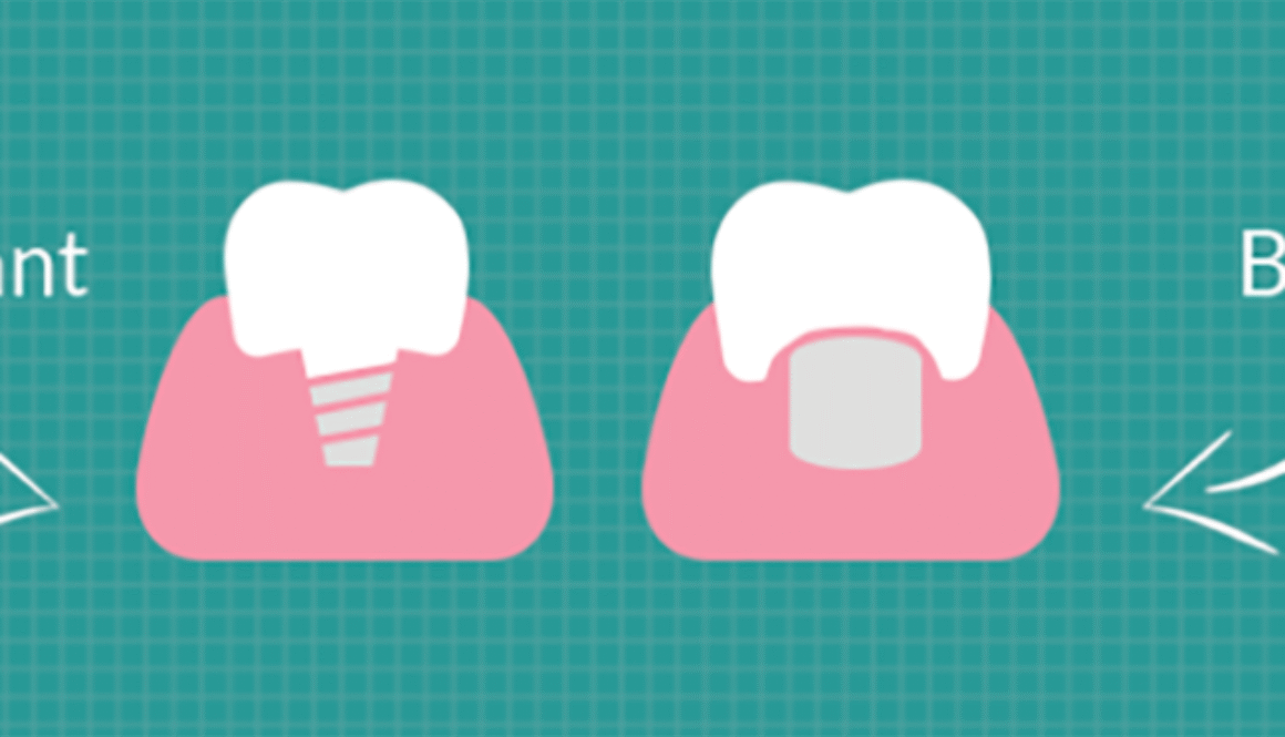 benefits-implant-versus-bridge