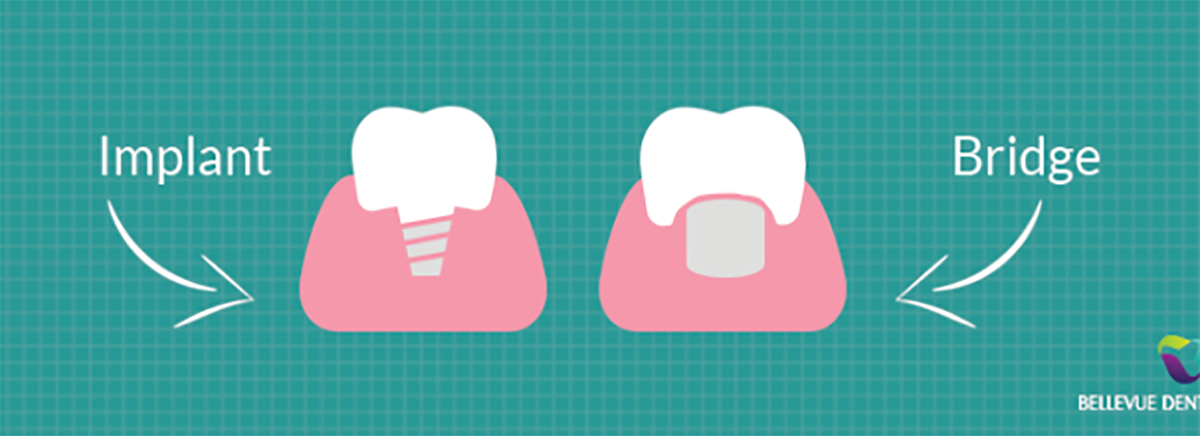 benefits-implant-versus-bridge