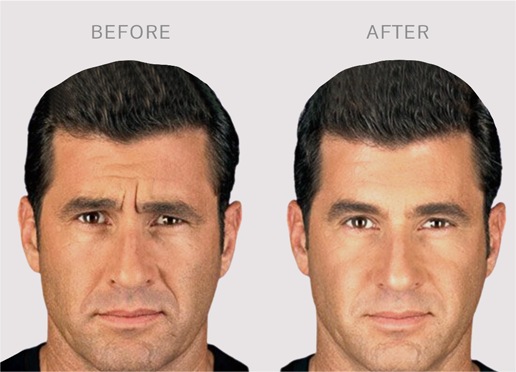 aesthetics-services--botox-2