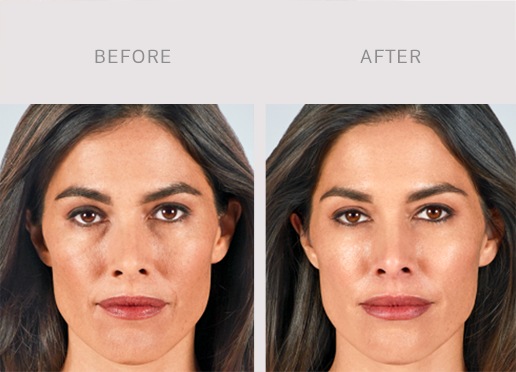 aesthetics-services--facial-filler-2