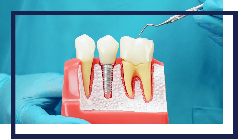 dentistry-cosmetic--implants