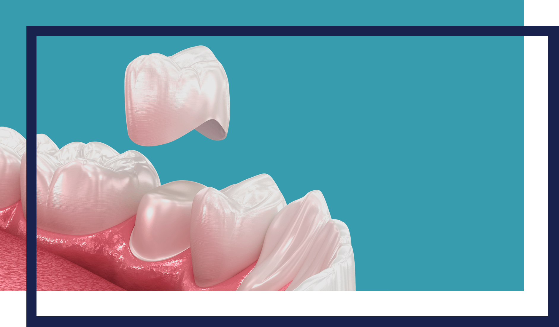 dentistry-genera--crowns