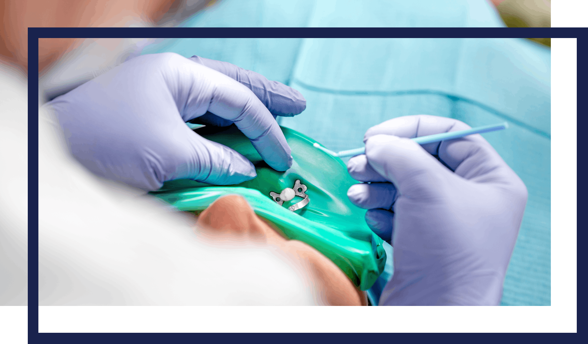 dentistry-genera--sealants